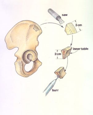 BoneGraft